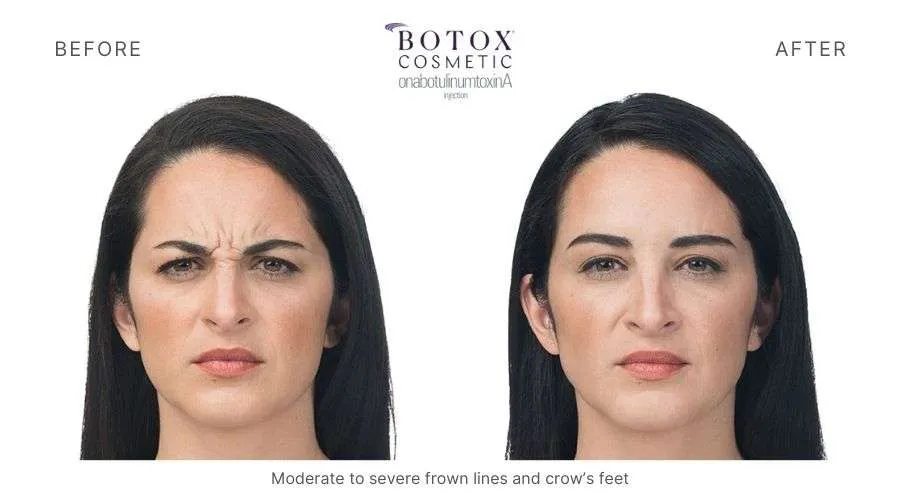 radiant-beauty-and-health-botox-before-and-after-2.webp