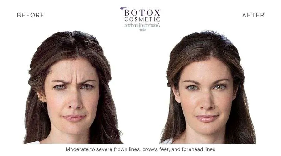 radiant-beauty-and-health-botox-before-and-after-3.webp